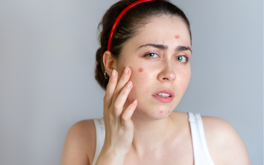 Pimples – Ultimate Home Remedies You Can Do It By Yourself #6